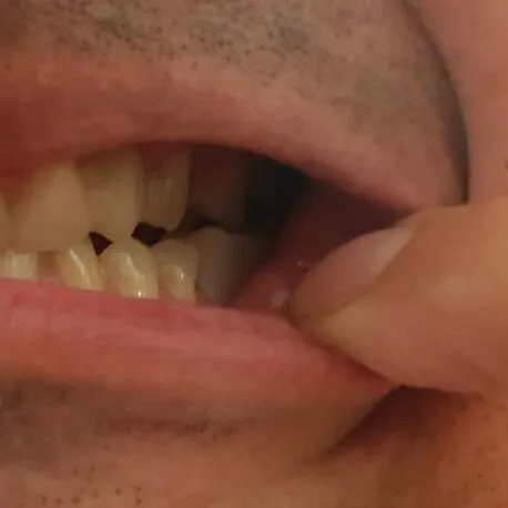 Denticor – PO