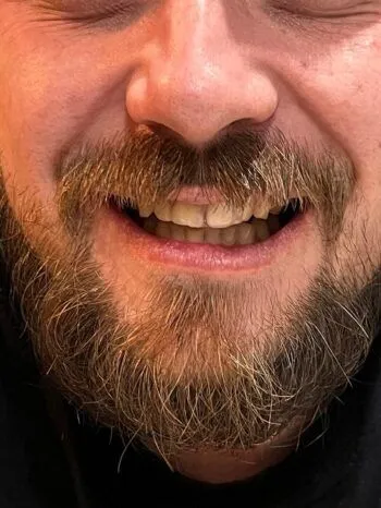 Zákazník — zlomený predný zub opravený Denticorom