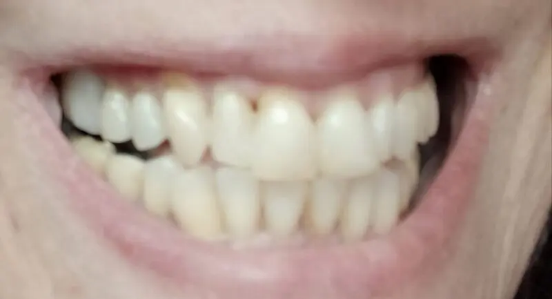 Zákazníčka — medzera zakrytá Denticorom