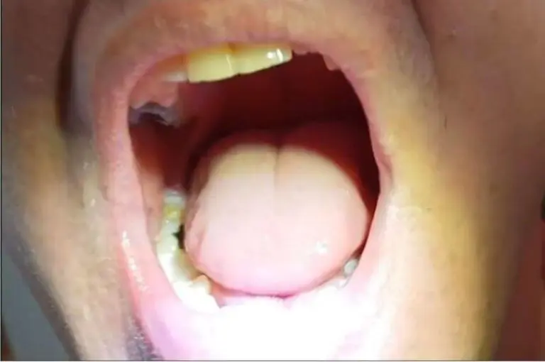 Zákazníčka — bočný zub doplnený Denticorom