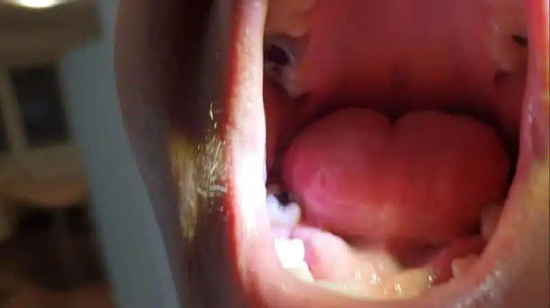 Zákazníčka — chýbajúci bočný zub