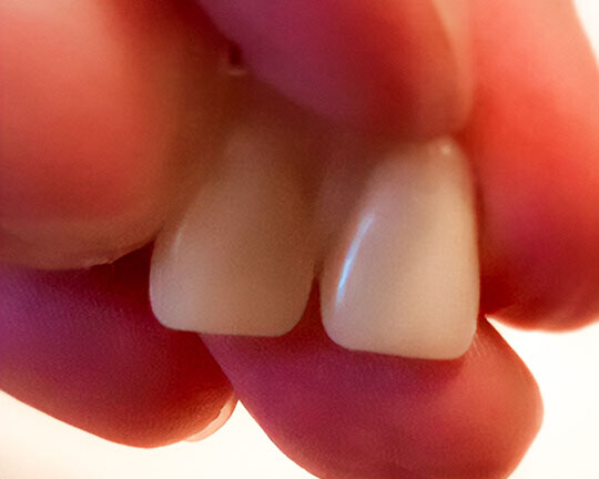 Nové predné zuby Denticor — detail náhrady v ruke