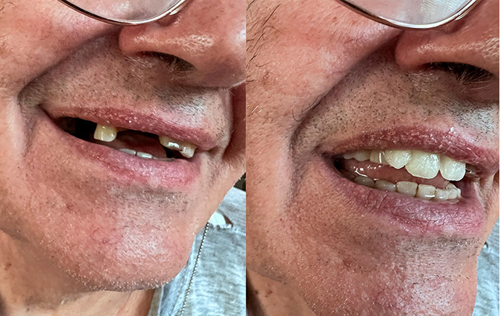 Zákazník — viacero chýbajúcich zubov pred a po Denticor