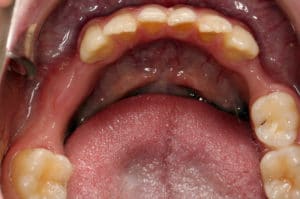 Koľko by asi platil u zubára tento pacient, ak by si nahradil všetky chýbajúce zuby? Zdroj: internet