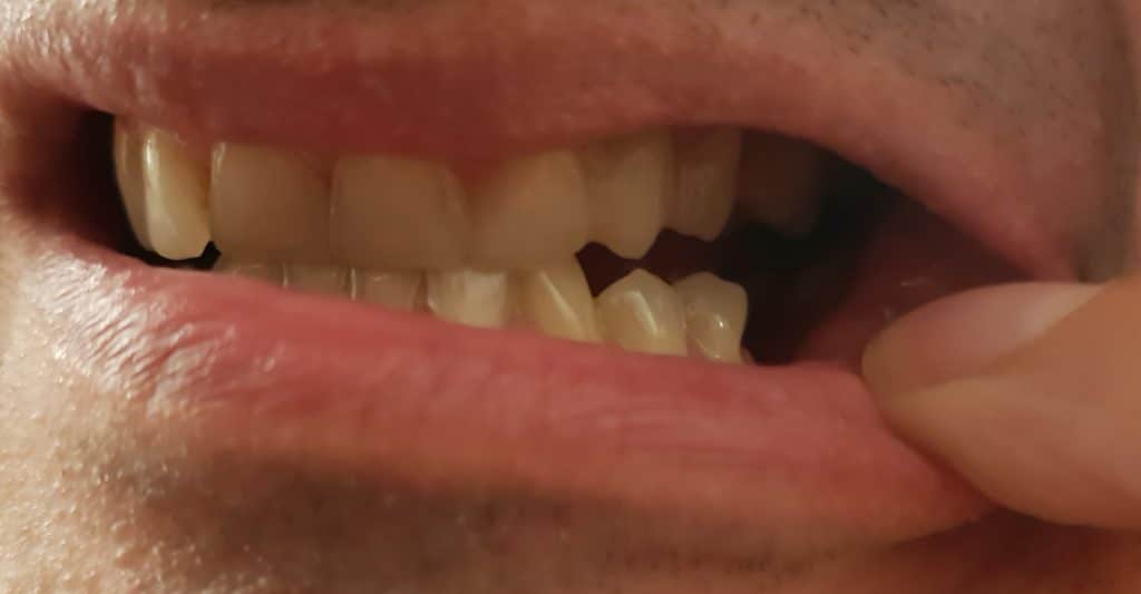 Stále som sa nemohol usmievať aj napriek novému očnému zubu. V úsmeve bolo vidno, že mi chýba ľavý zadný zub.