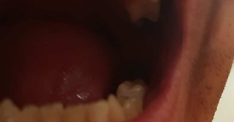 Predný pohľad na moju novú dolnú a hornú stoličku Denticor - ľavá strana. Oba zuby som si urobil a nahradil sám. Keď som to zvládol ja, zvládne to naozaj každý.