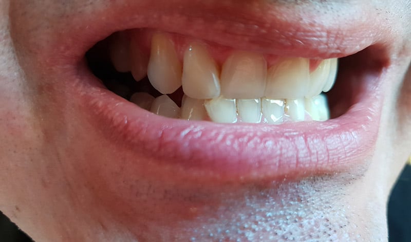 Chýbajúce zuby z obrázku vyššie som si nahradil Denticorom. Rýchlo, efektívne a bezbolestne. Perfektný estetický výsledok. V úsmeve a počas rozhovoru, vynikajúce.
