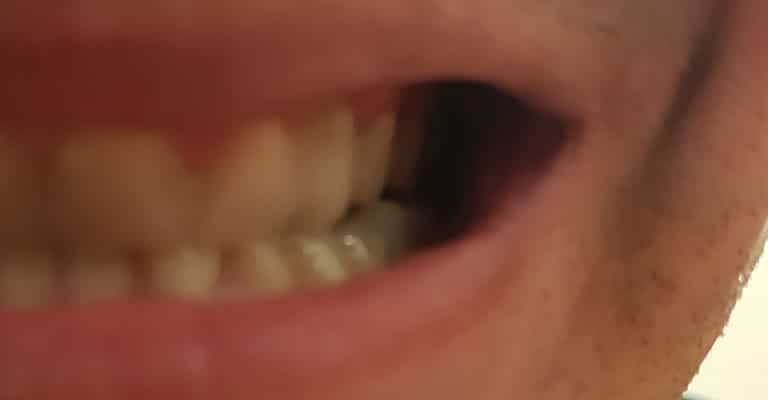 Môj kompletný úsmev vďaka produktu Denticor. Keď to pomohlo mne, verím že Denticor pomôže každému s rovnakými problémami, ako mám ja. Ale nepredbiehajme, čítajte ďalej.