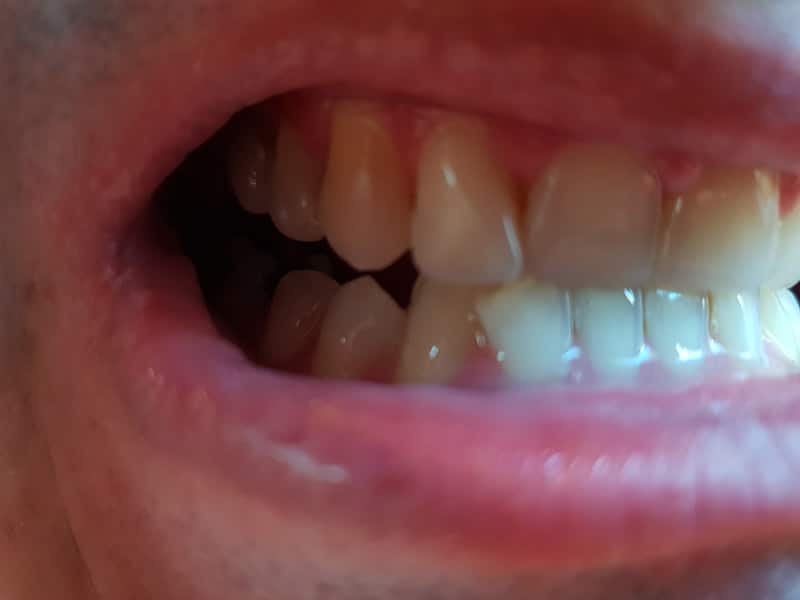 Nahradenie mojich chýbajúcich zubov zubnými náhradami Denticor - bližší pohľad.