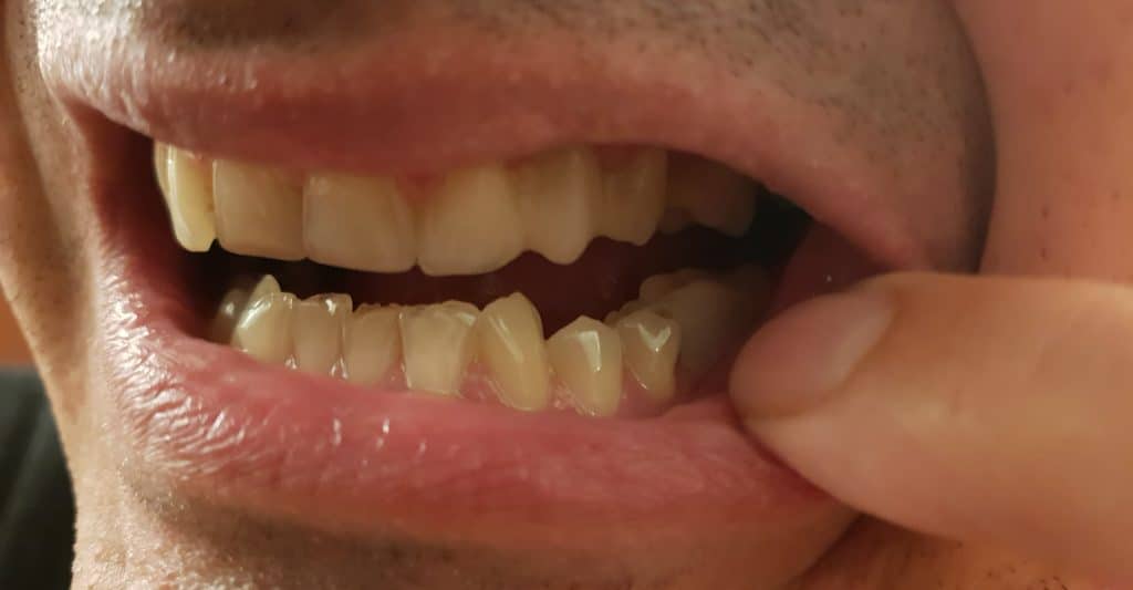 Porovnanie pred a po náhrade chýbajúceho zubu produktom Denticor,