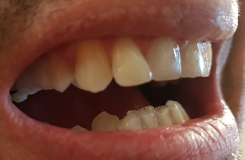 Vytvorenie mostíka a vloženie do diery po chýbajúcich zuboch. Mostík je pripravený na vloženie zubných koruniek.