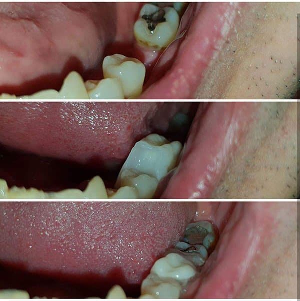 Denticor si vložíte na miesto chýbajúceho zubu. Žiadna bolesť, vŕtanie ani sekanie.