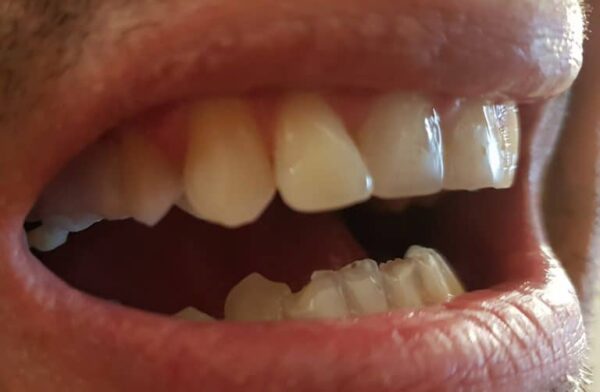 Zubný mostík - hmotu vložíme na miesto, kde chýbajú zuby