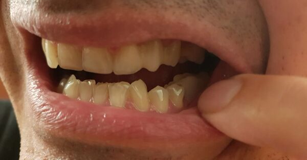 Dolná stolička – po nahradení zubnou náhradou Denticor Dolná stolička - po nahradení zubnou náhradou Denticor