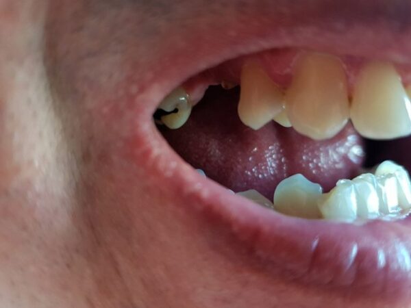 Stav na začiatku - chýbajúce horné zuby