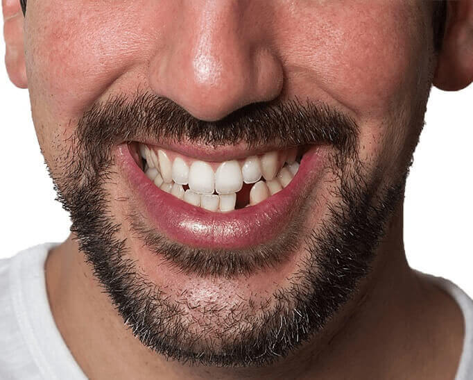 chybajuci-zub-predny