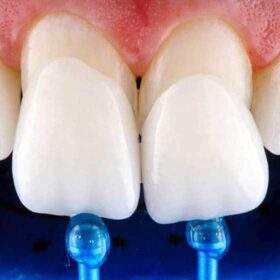 fazety Denticor esteticke prekrytie zubov