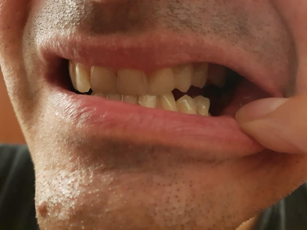 Chýbajúce zadné zuby viditeľné v úsmeve a počas rozprávania.