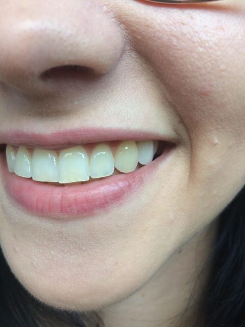 Po nahradení zuba Denticorom výsledok esteticky vynikajúci.
