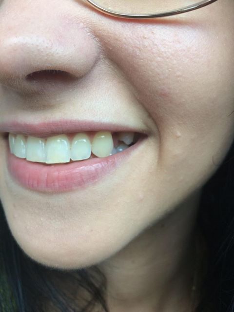 Zákazníčka s chýbajúcim bočným zubom viditeľným v úsmeve.