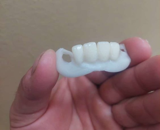 Zubná náhrada pre 4 predné chýbajúce zuby vedľa seba, ktorú si urobil zákazník na svoju mieru. Foto: zákazník