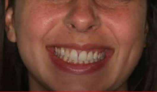 Predný zub nahradený novou zubnou korunkou.