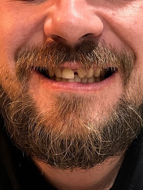 Poškodený predný zub - veľmi zlý estetický dojem