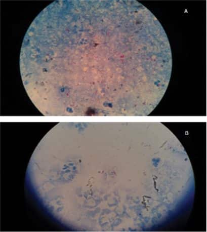 Vzorka slín pod mikroskopom, A. - vzorka slín bez použitia sódy bikarbóny, B. - vzorka slín po umytí zubov s pastou obsahujúcou sódu bikarbónu, výrazné zníženie počtu sledovaných baktérií