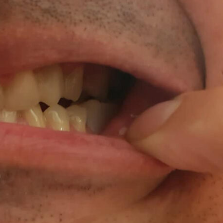Nový zub v ústach