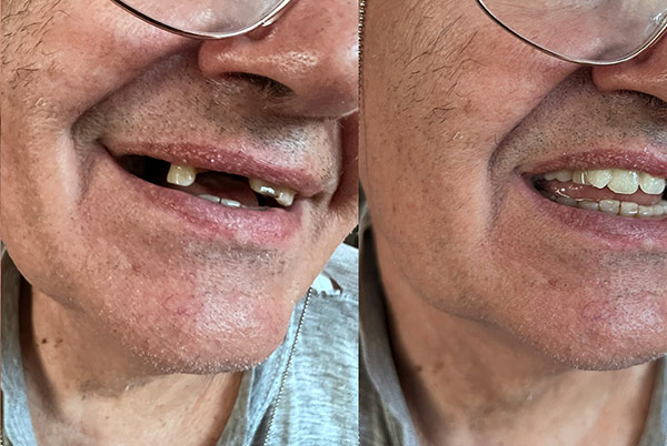 Denticor pred a po.